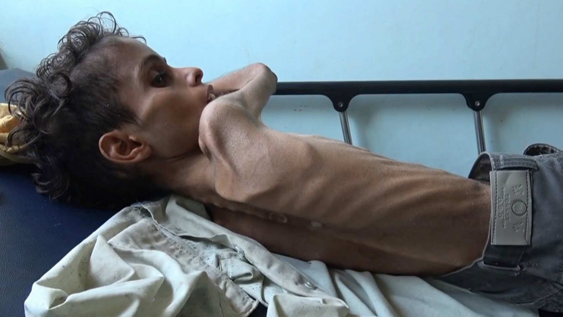 Yemen child starvation famine AFP