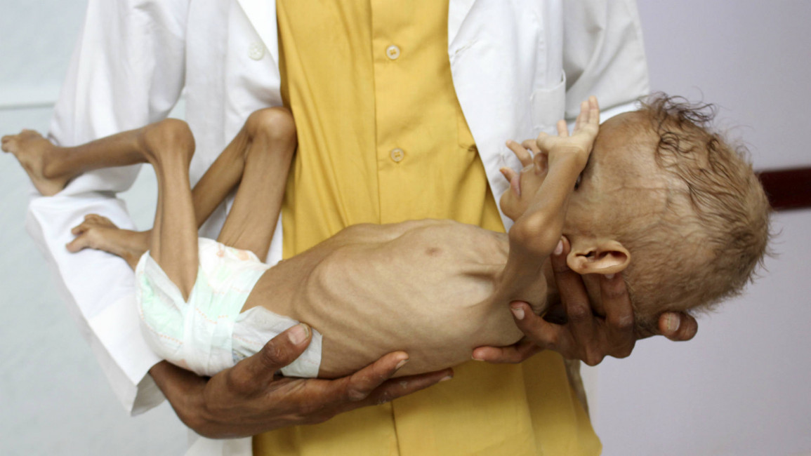 Yemen malnourished child AFP